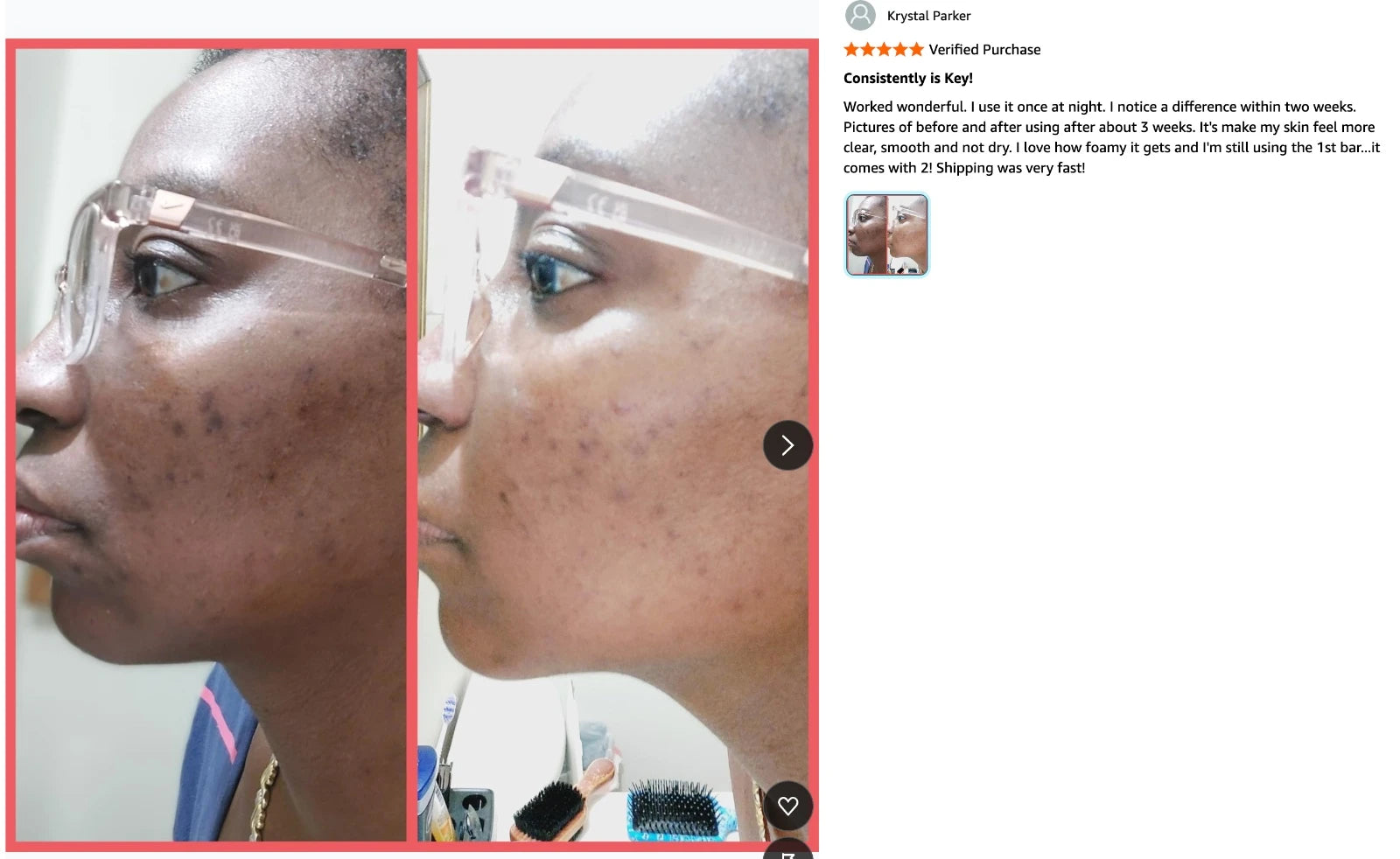 Before and after results showing reduced dark spots and clearer skin after using AMVital Turmeric Soap, shared by a verified customer.