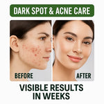 AMVital Before and after comparison of dark spot and acne care treatment on a woman's face.