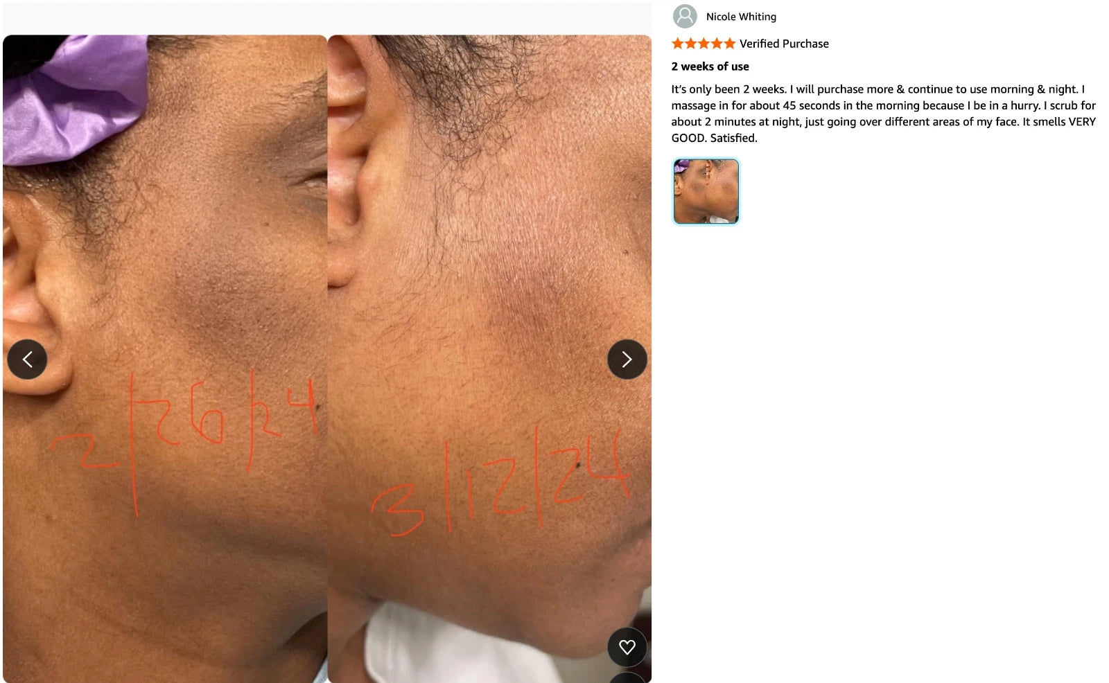 Before and after results after 2 weeks of using AMVital Turmeric Soap — visible reduction in dark patches and smoother, even-toned skin